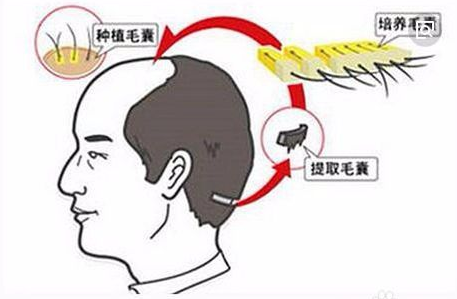 国际最新脱发治疗技术，重塑自信的秘密武器